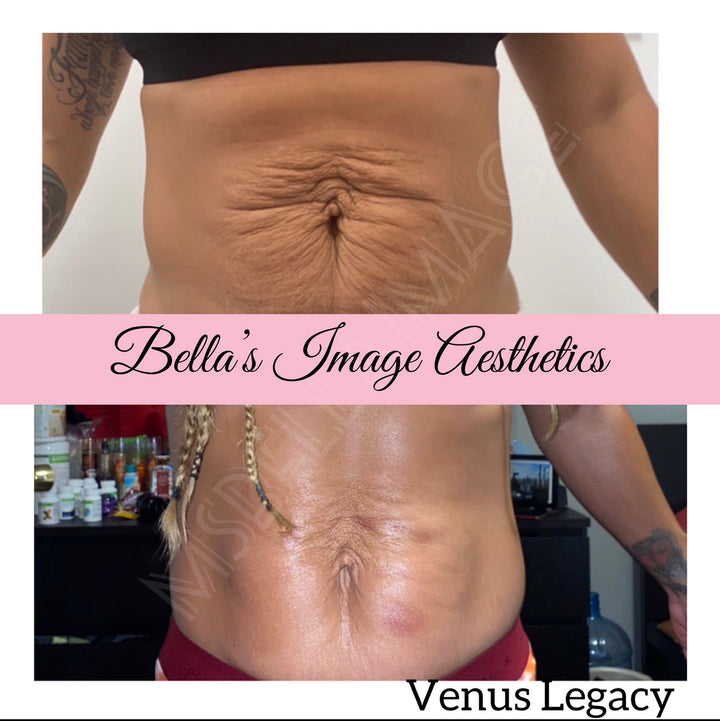 VENUS LEGACY -SKIN TIGHTENING