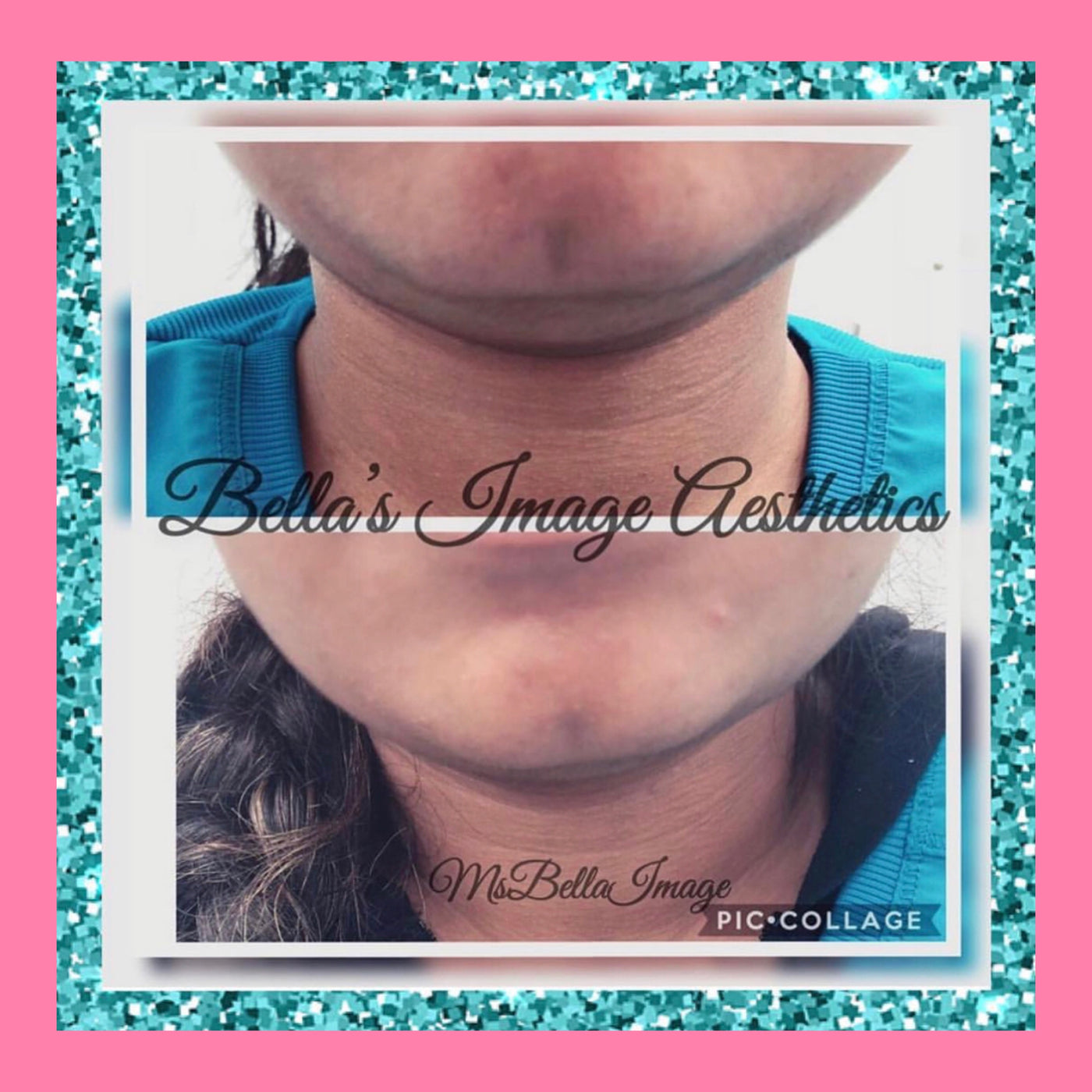 DOUBLE CHIN REDUCTION