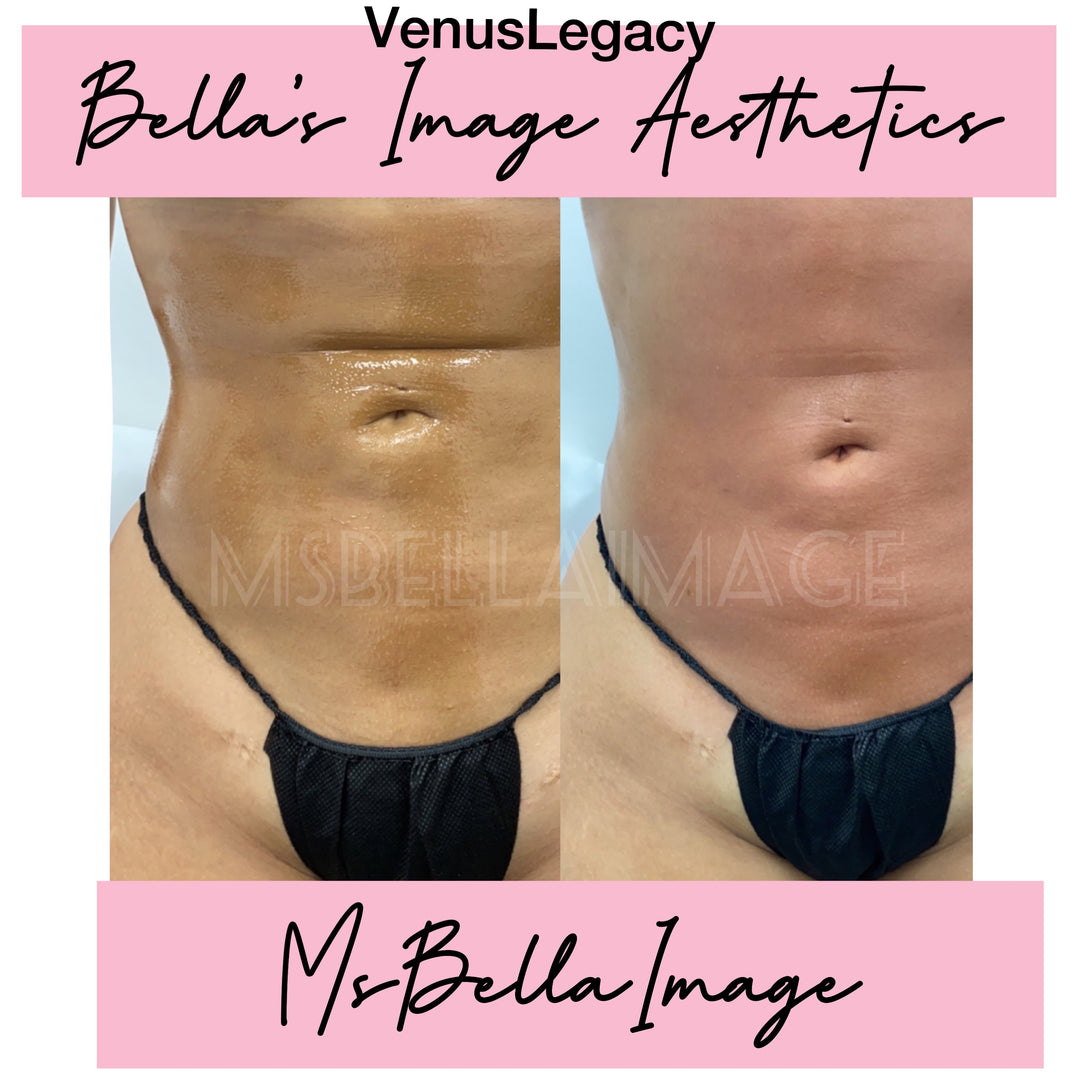 VENUS LEGACY -SKIN TIGHTENING